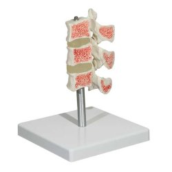 Osteoporose model