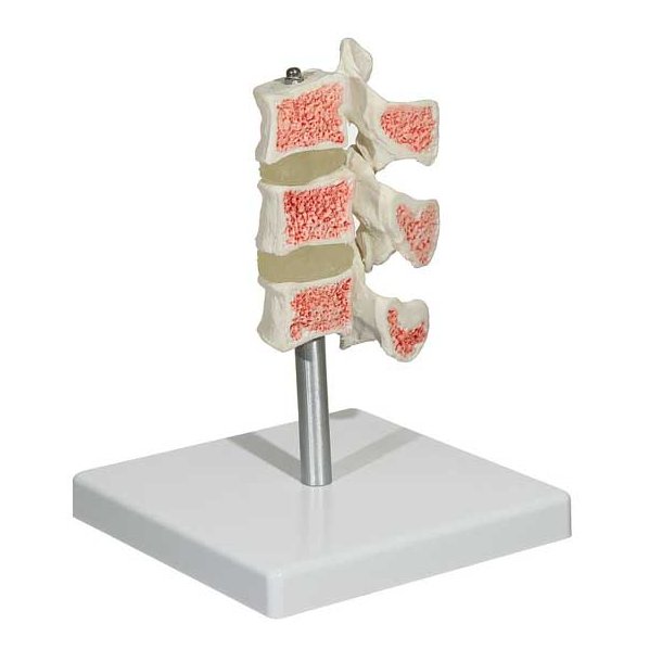 Osteoporose model